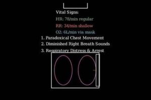 Disaster Chest Trauma: Stretcher Transport & Care | Disaster Information Hub – Latest Natural Disaster News & Emergency Resources